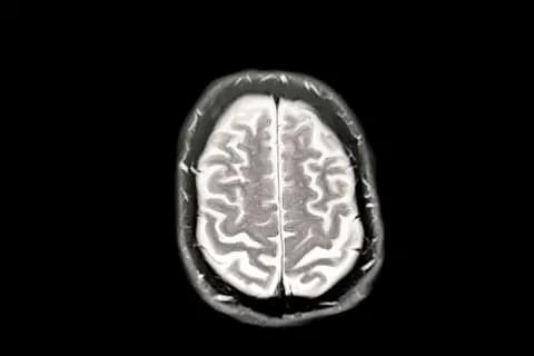 Getty Images A scan of a brain showing early Dementia/Alzheimer's